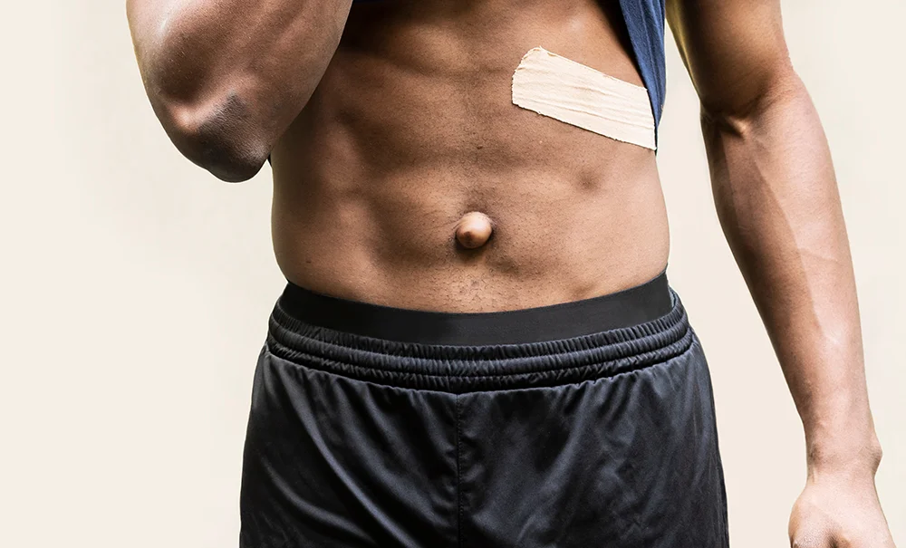 Abaulamento típico de hérnia umbilical próximo ao umbigo em paciente em repouso